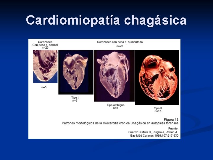Cardiomiopatía chagásica 