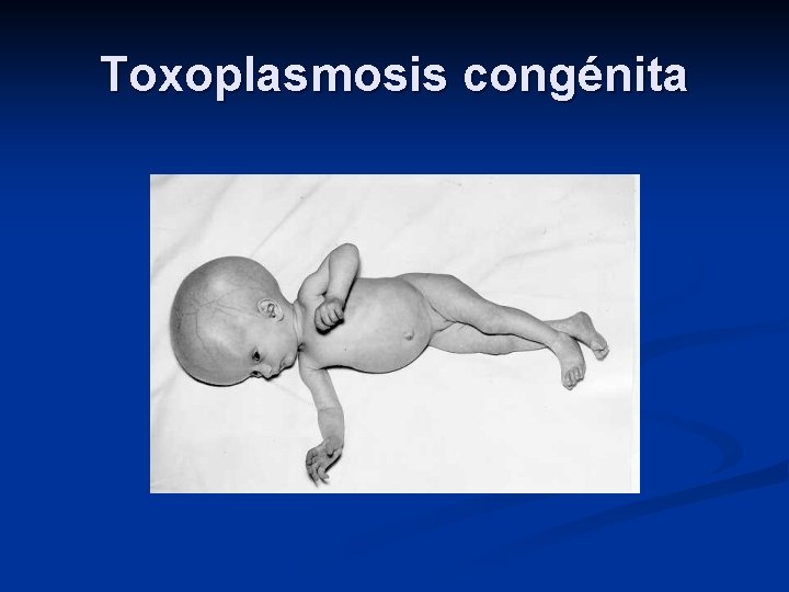 Toxoplasmosis congénita 