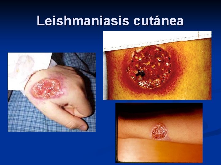 Leishmaniasis cutánea 