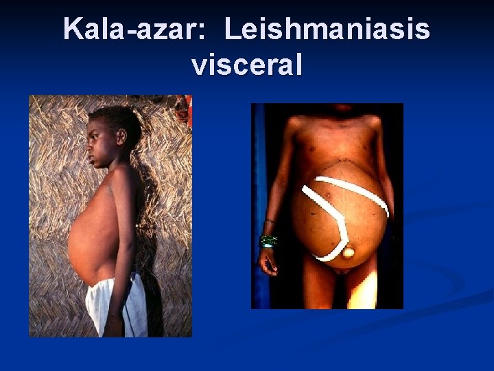 Kala-azar: Leishmaniasis visceral 