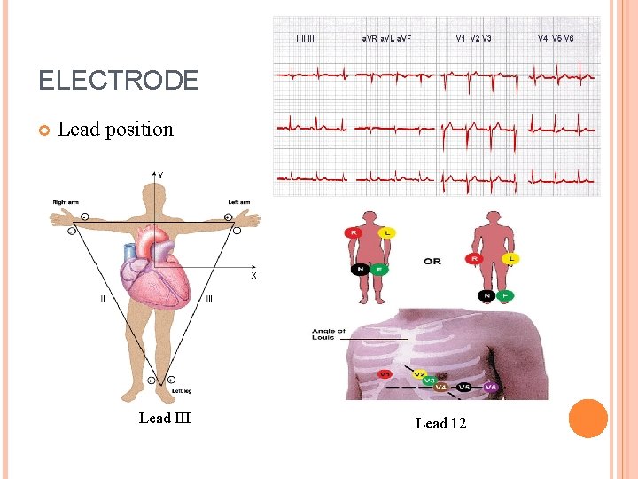 ELECTRODE Lead position Lead III Lead 12 