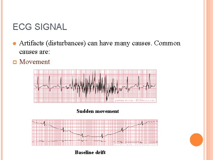 ECG SIGNAL Artifacts (disturbances) can have many causes. Common causes are: p Movement l