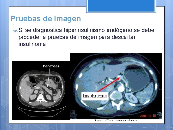 Pruebas de Imagen Si se diagnostica hiperinsulinismo endógeno se debe proceder a pruebas de