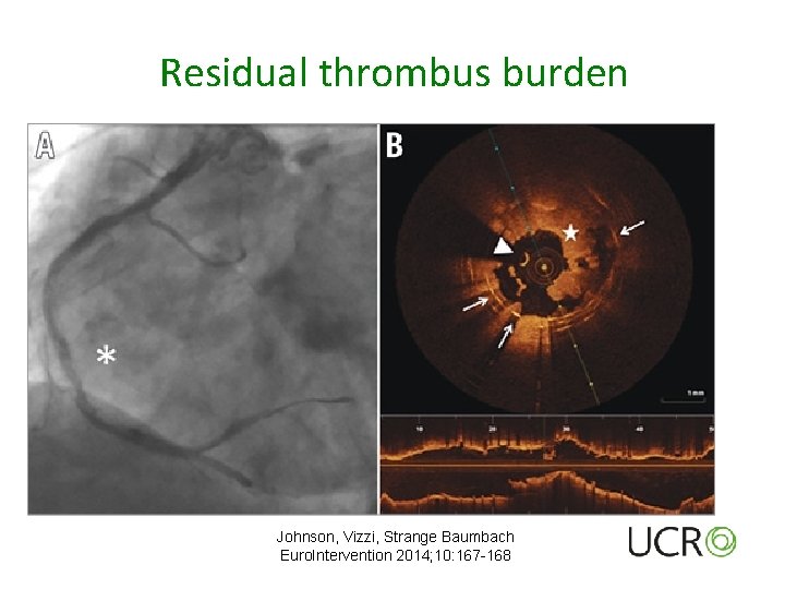 Residual thrombus burden Johnson, Vizzi, Strange Baumbach Euro. Intervention 2014; 10: 167 -168 