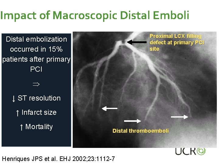 Impact of Macroscopic Distal Emboli Proximal LCX filling defect at primary PCI site Distal