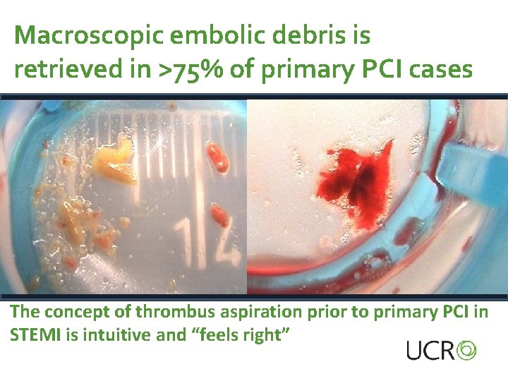 Macroscopic embolic debris is retrieved in >75% of primary PCI cases The concept of