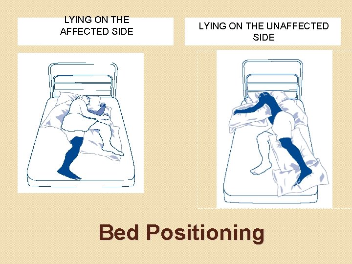 LYING ON THE AFFECTED SIDE LYING ON THE UNAFFECTED SIDE Bed Positioning 