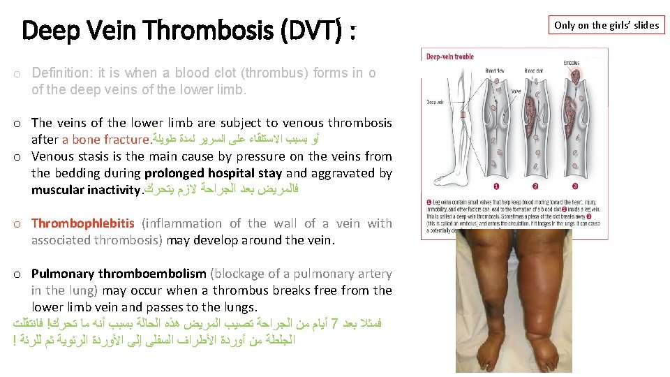 Deep Vein Thrombosis (DVT) : o Definition: it is when a blood clot (thrombus)