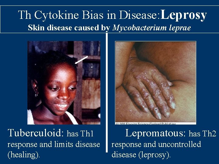 Th Cytokine Bias in Disease: Leprosy Skin disease caused by Mycobacterium leprae Tuberculoid: has