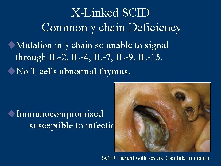 X-Linked SCID Common g chain Deficiency u. Mutation in g chain so unable to