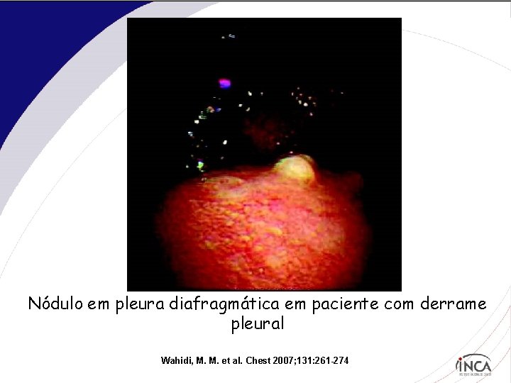 Nódulo em pleura diafragmática em paciente com derrame pleural Wahidi, M. M. et al.