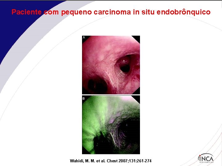 Paciente com pequeno carcinoma in situ endobrônquico Wahidi, M. M. et al. Chest 2007;
