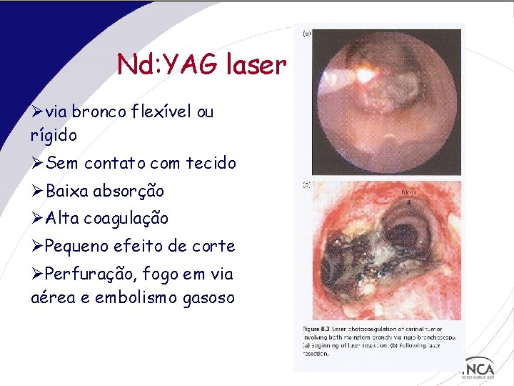 Nd: YAG laser Øvia bronco flexível ou rígido ØSem contato com tecido ØBaixa absorção