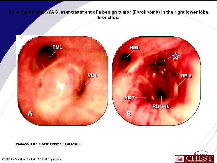 An example of Nd-YAG laser treatment of a benign tumor (fibrolipoma) in the right