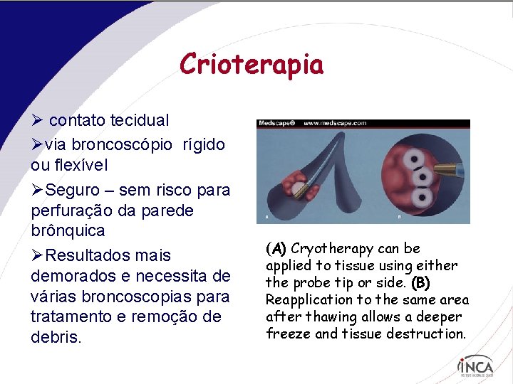 Crioterapia Ø contato tecidual Øvia broncoscópio rígido ou flexível ØSeguro – sem risco para