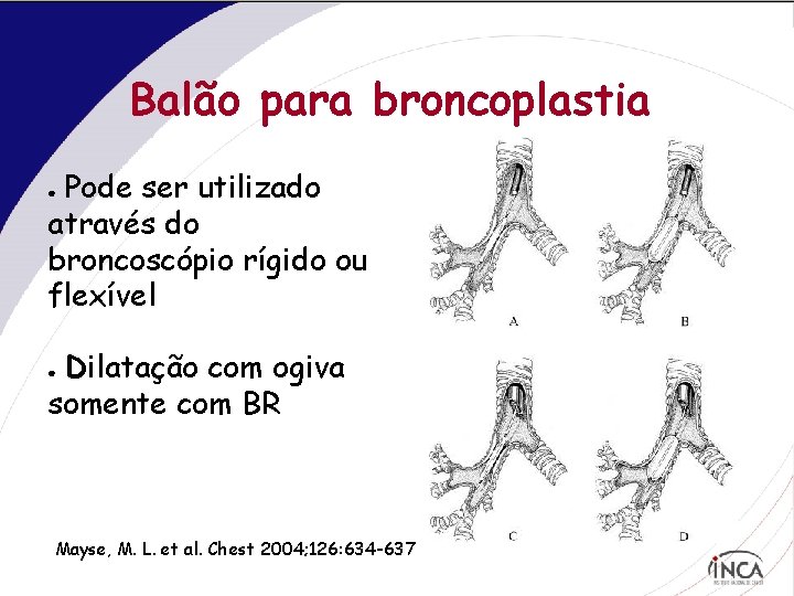 Balão para broncoplastia Pode ser utilizado através do broncoscópio rígido ou flexível ● Dilatação