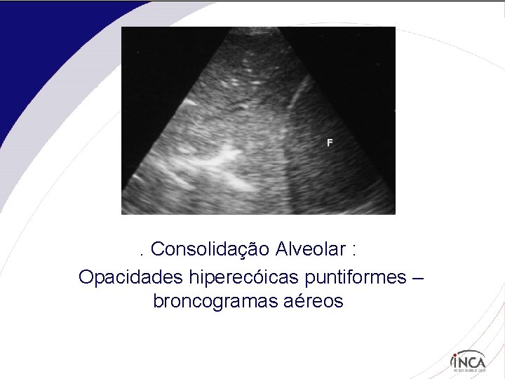 . Consolidação Alveolar : Opacidades hiperecóicas puntiformes – broncogramas aéreos 