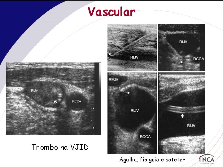 Vascular Trombo na VJID Agulha, fio guia e cateter 