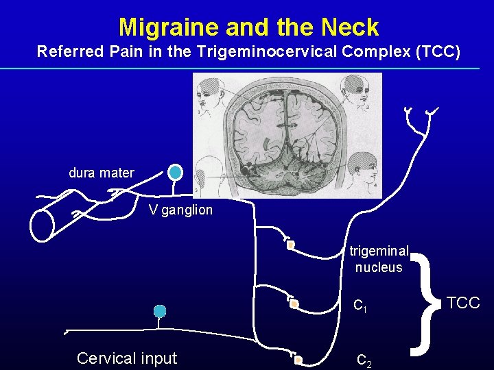 Migraine and the Neck Referred Pain in the Trigeminocervical Complex (TCC) dura mater V