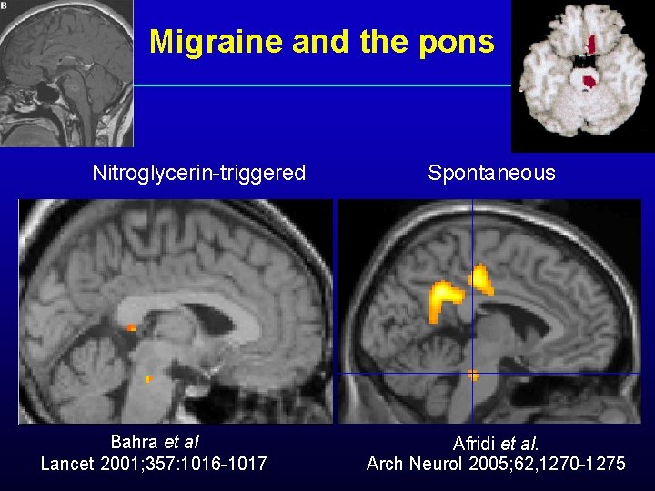 Migraine and the pons Nitroglycerin-triggered Bahra et al Lancet 2001; 357: 1016 -1017 Spontaneous