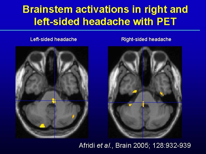 Brainstem activations in right and left-sided headache with PET Left-sided headache Right-sided headache Afridi