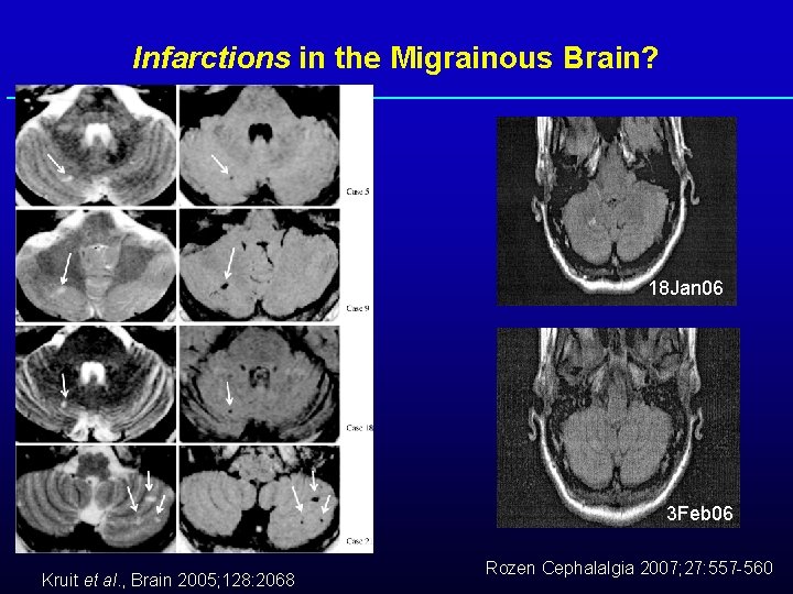 Infarctions in the Migrainous Brain? 18 Jan 06 3 Feb 06 Kruit et al.