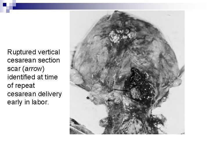 Ruptured vertical cesarean section scar (arrow) identified at time of repeat cesarean delivery early