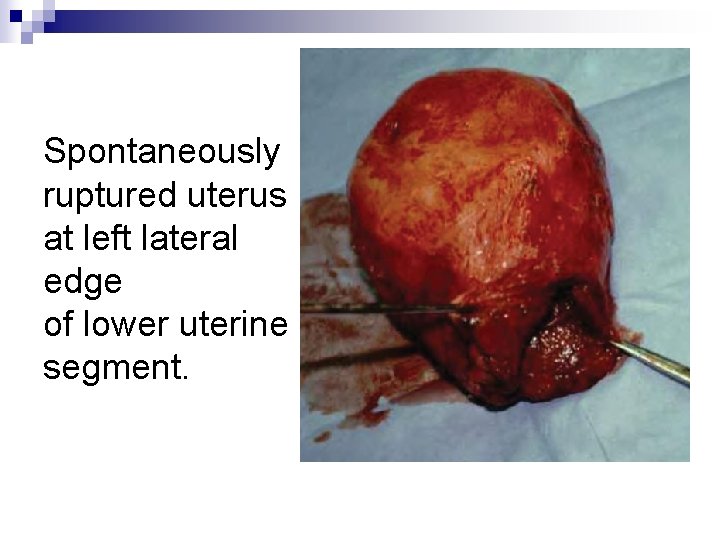 Spontaneously ruptured uterus at left lateral edge of lower uterine segment. 