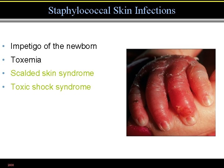 Staphylococcal Skin Infections • Impetigo of the newborn • Toxemia • Scalded skin syndrome