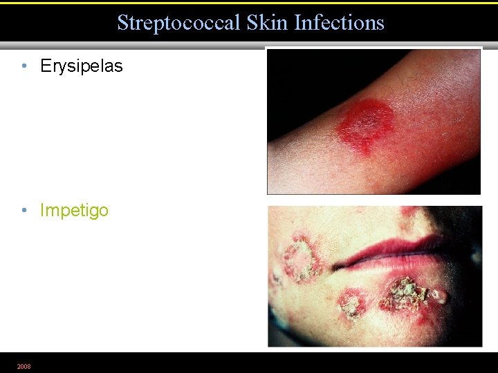 Streptococcal Skin Infections • Erysipelas • Impetigo 2008 Figure 21. 6, 7 