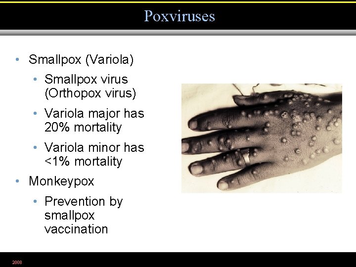 Poxviruses • Smallpox (Variola) • Smallpox virus (Orthopox virus) • Variola major has 20%