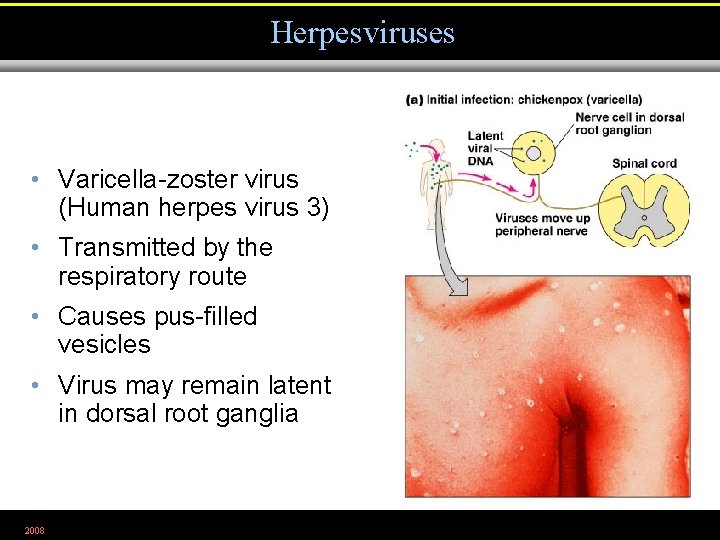 Herpesviruses • Varicella-zoster virus (Human herpes virus 3) • Transmitted by the respiratory route