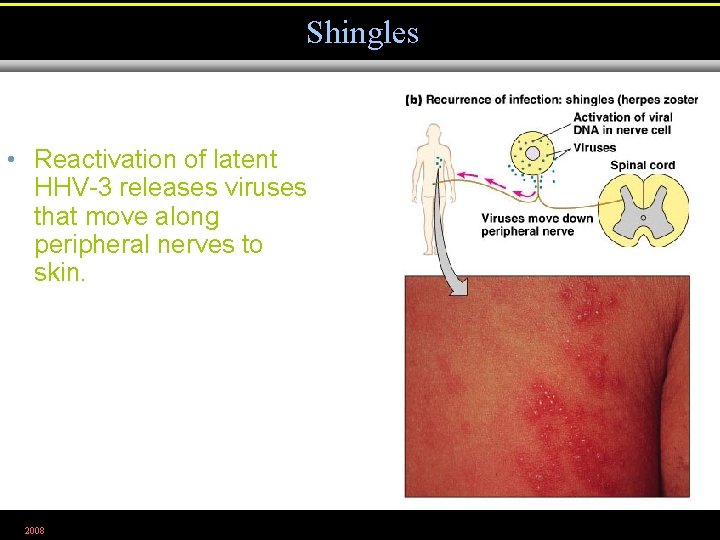 Shingles • Reactivation of latent HHV-3 releases viruses that move along peripheral nerves to