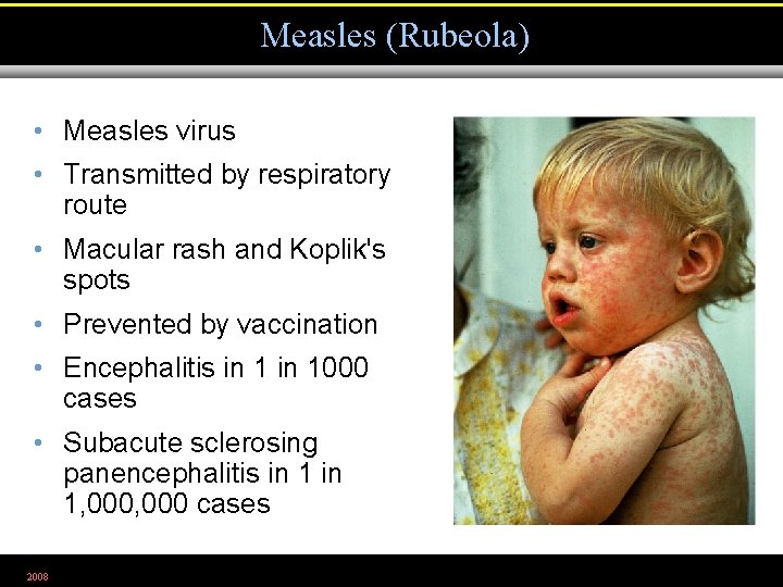 Measles (Rubeola) • Measles virus • Transmitted by respiratory route • Macular rash and