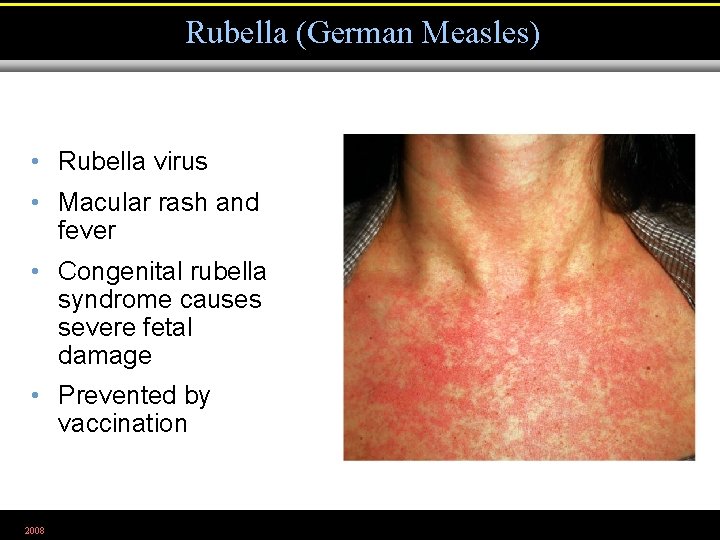 Rubella (German Measles) • Rubella virus • Macular rash and fever • Congenital rubella