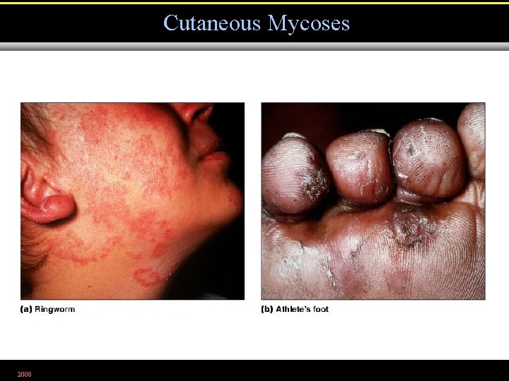 Cutaneous Mycoses 2008 Figure 21. 16 