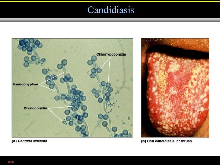 Candidiasis 2008 Figure 21. 17 