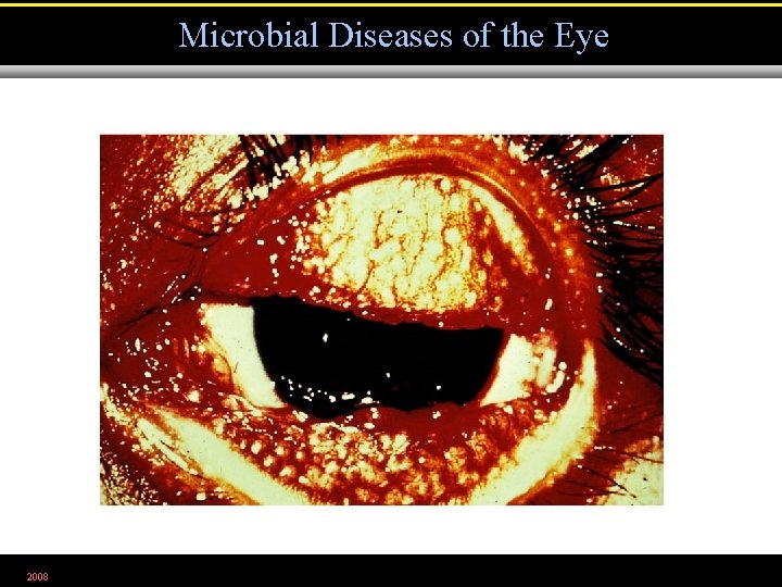 Microbial Diseases of the Eye 2008 Figure 21. 20 