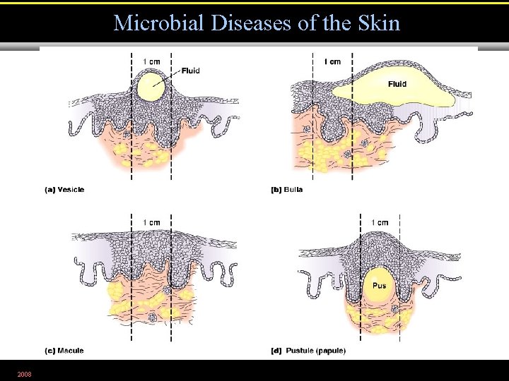 Microbial Diseases of the Skin 2008 Figure 21. 2 