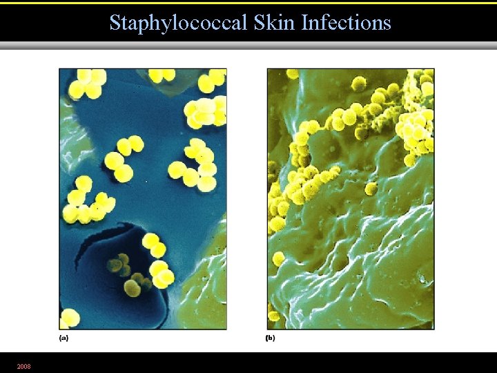 Staphylococcal Skin Infections 2008 Figure 21. 3 