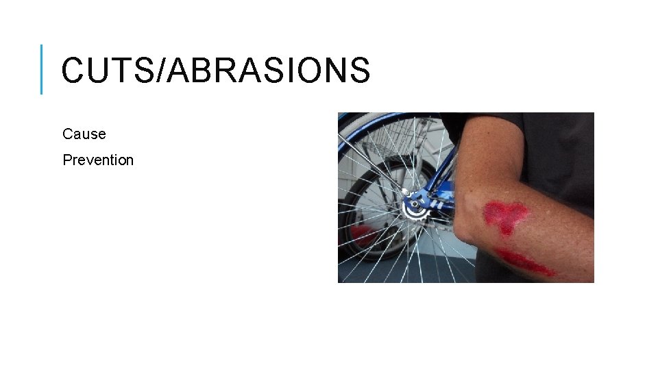 CUTS/ABRASIONS Cause Prevention 