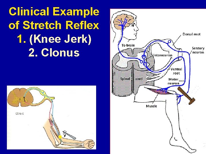 Clinical Example of Stretch Reflex 1. (Knee Jerk) 2. Clonus 