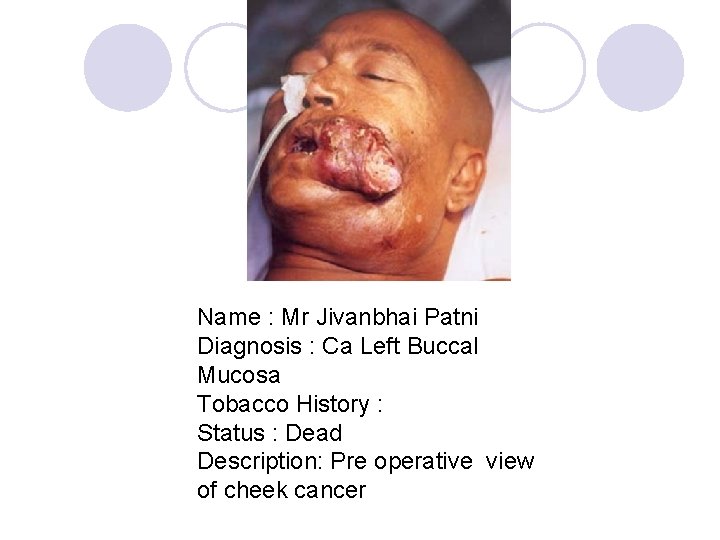 Name : Mr Jivanbhai Patni Diagnosis : Ca Left Buccal Mucosa Tobacco History :