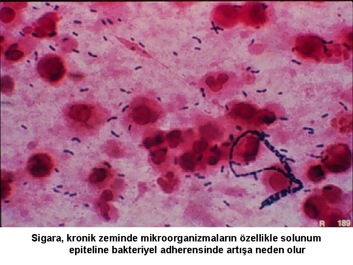 Sigara, kronik zeminde mikroorganizmaların özellikle solunum epiteline bakteriyel adherensinde artışa neden olur 