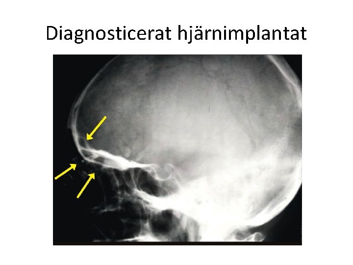 Diagnosticerat hjärnimplantat 