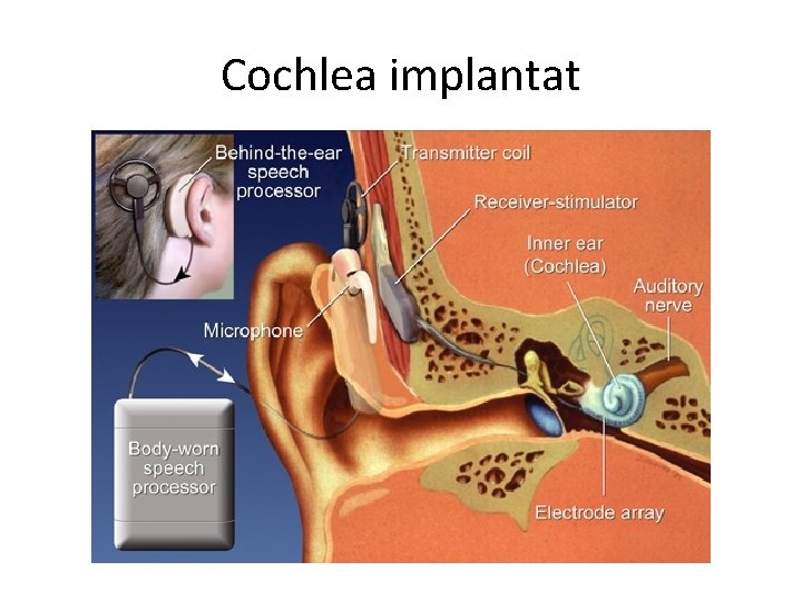 Cochlea implantat 