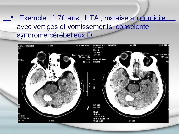  • Exemple : f, 70 ans ; HTA ; malaise au domicile avec