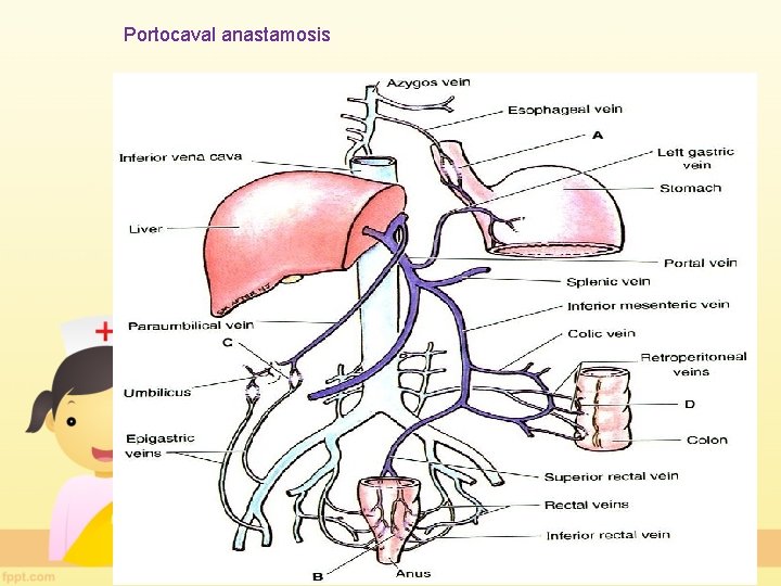 Portocaval anastamosis 