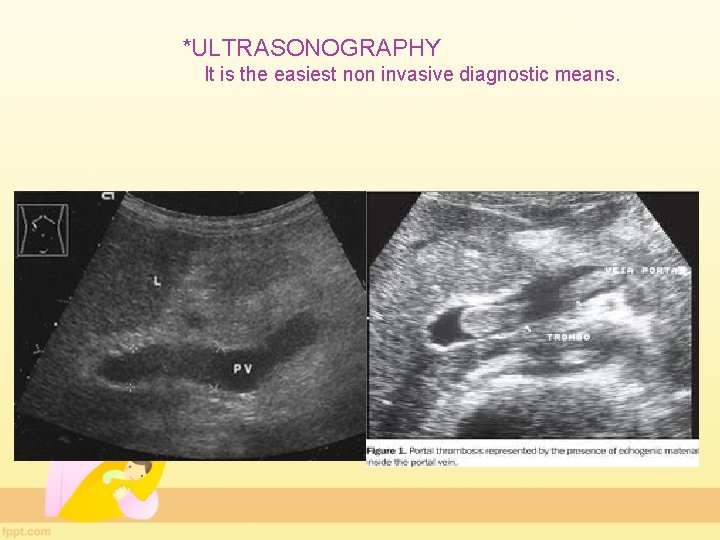 *ULTRASONOGRAPHY It is the easiest non invasive diagnostic means. 