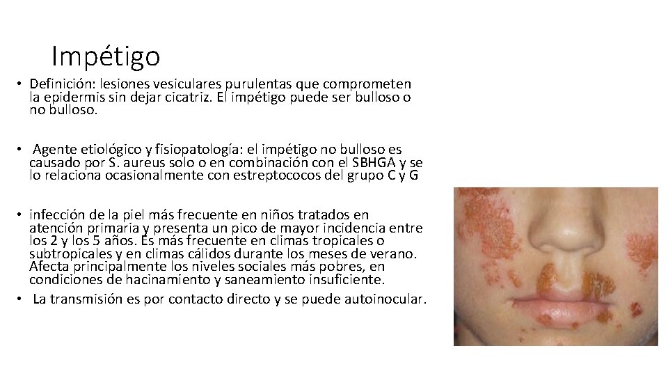 Impétigo • Definición: lesiones vesiculares purulentas que comprometen la epidermis sin dejar cicatriz. El